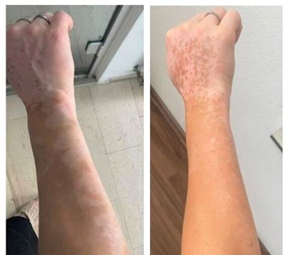 Vitiligo a kézen UVB fényterápia előtt és után
