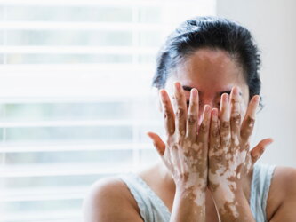A vitiligo kezelését befolyásoló tényezők