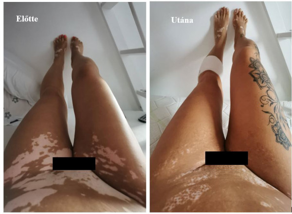 Vitiligo nő