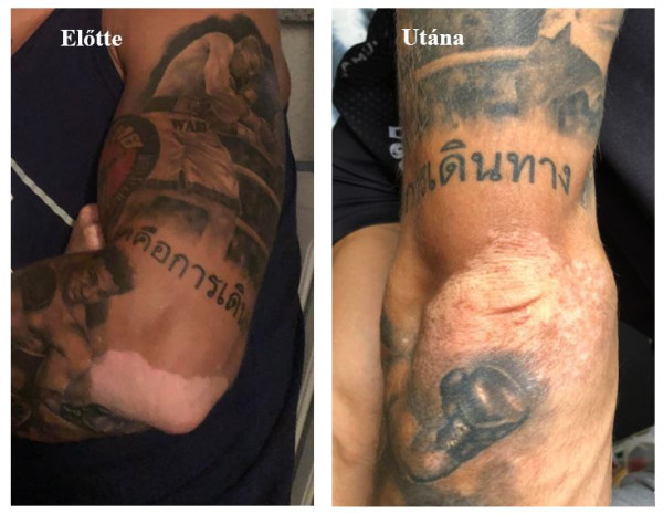 Vitiligo könyök