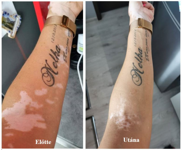 Vitiligo repigmentáció