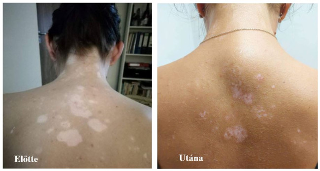 Vitiligo vissza