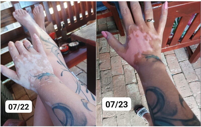  Vitiligo kezek