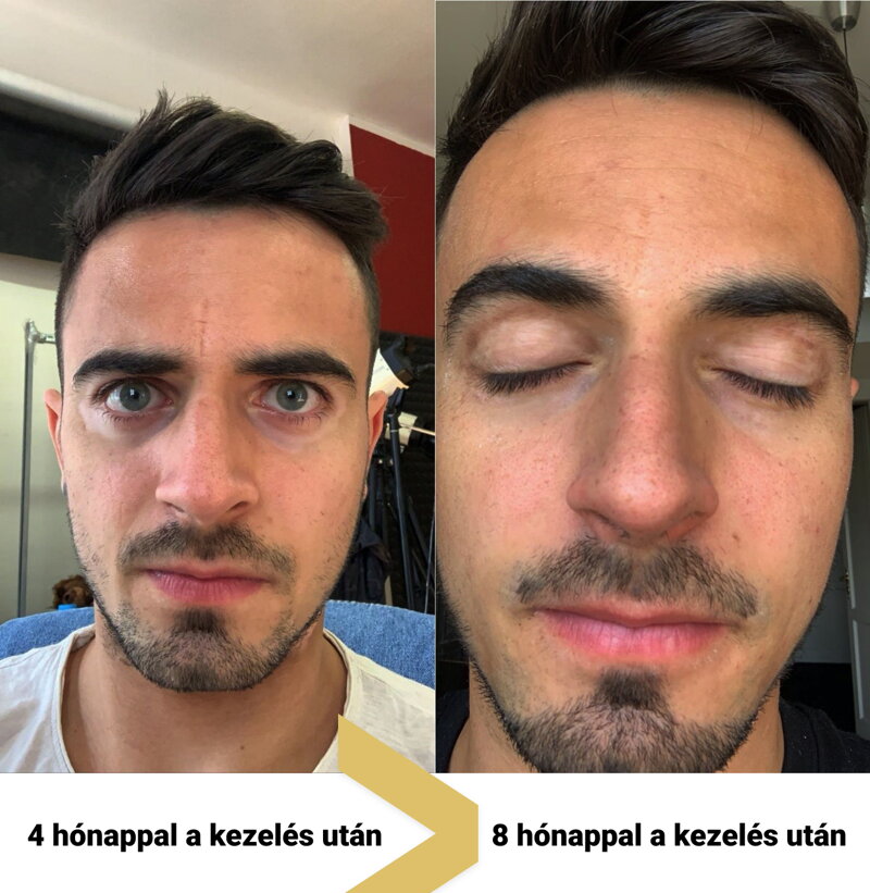  vitiligo kezelés
