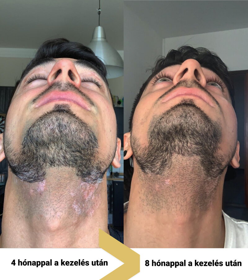 vitiligo az arcon