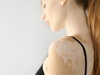 Vitiligo: Az első tünetek, diagnózis, kezelési lehetőségek és életmódbeli tanácsok