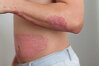 Nem minden egyes fehér folt VITILIGO | Vitiligoshop.hu