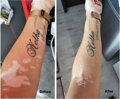 Vitiligo Indulócsomag (200 ml Gél, 60 db Tabletta és Zanderm Korrektor)