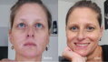 Vitiligo Indulócsomag (200 ml Gél, 60 db Tabletta és Zanderm Korrektor)