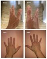 Vitiligo Indulócsomag (200 ml Gél, 60 db Tabletta és Zanderm Korrektor)