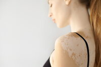 Vitiligo - pigmentvesztés Vitiligo - pigmentvesztés