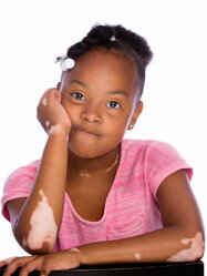 Vitiligo a gyerekeknél