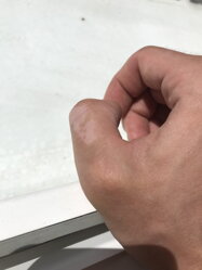 Repigmentáció Repigmentáció
