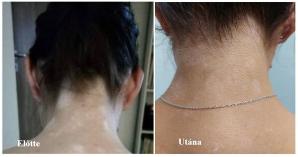 Vitiligo a tarkón
