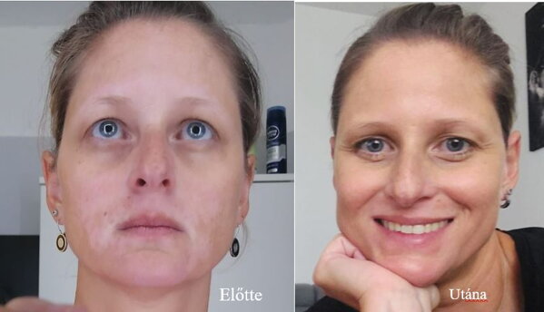 Vitiligo az arcon előtte és utána