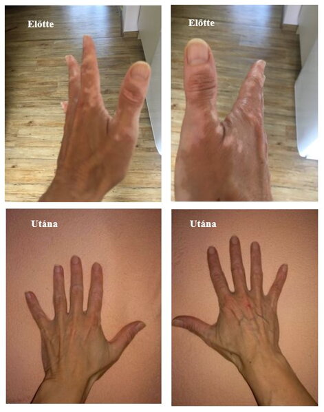 Vitiligo a kézen előtte és utána