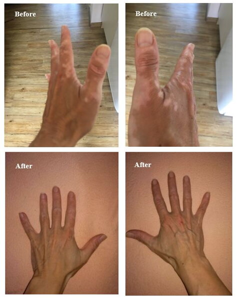 Aktív vagy stabil vitiligo? Hogyan ismerhető fel a terjedés, és mit változtat a kezelésen