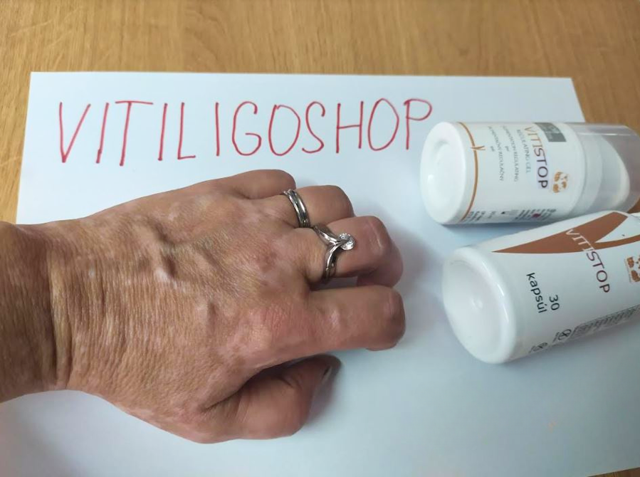 Vitiligo a kézen – Judit V., a VitiligoShop vásárlója