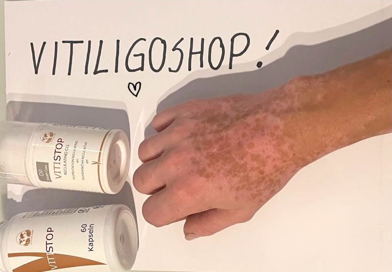 Vitiligo a kézen és az ujjakon – Júlia, a VitiligoShop vásárlója